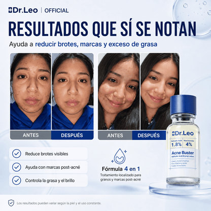 Loción Secante de Acné 4 en 1